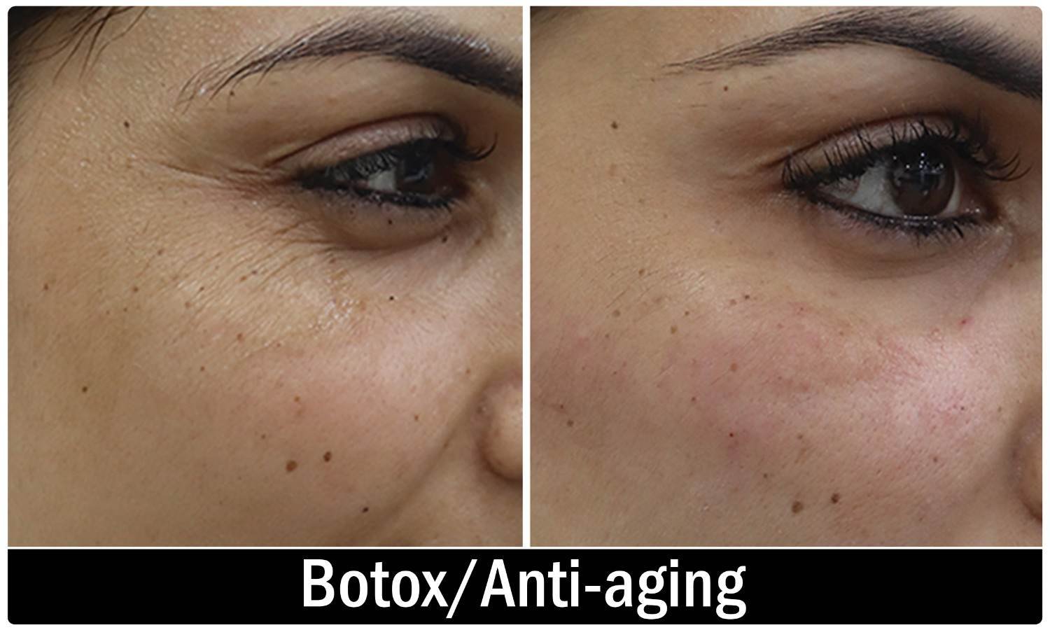 Botox consultation at Symmetrica, Siliguri