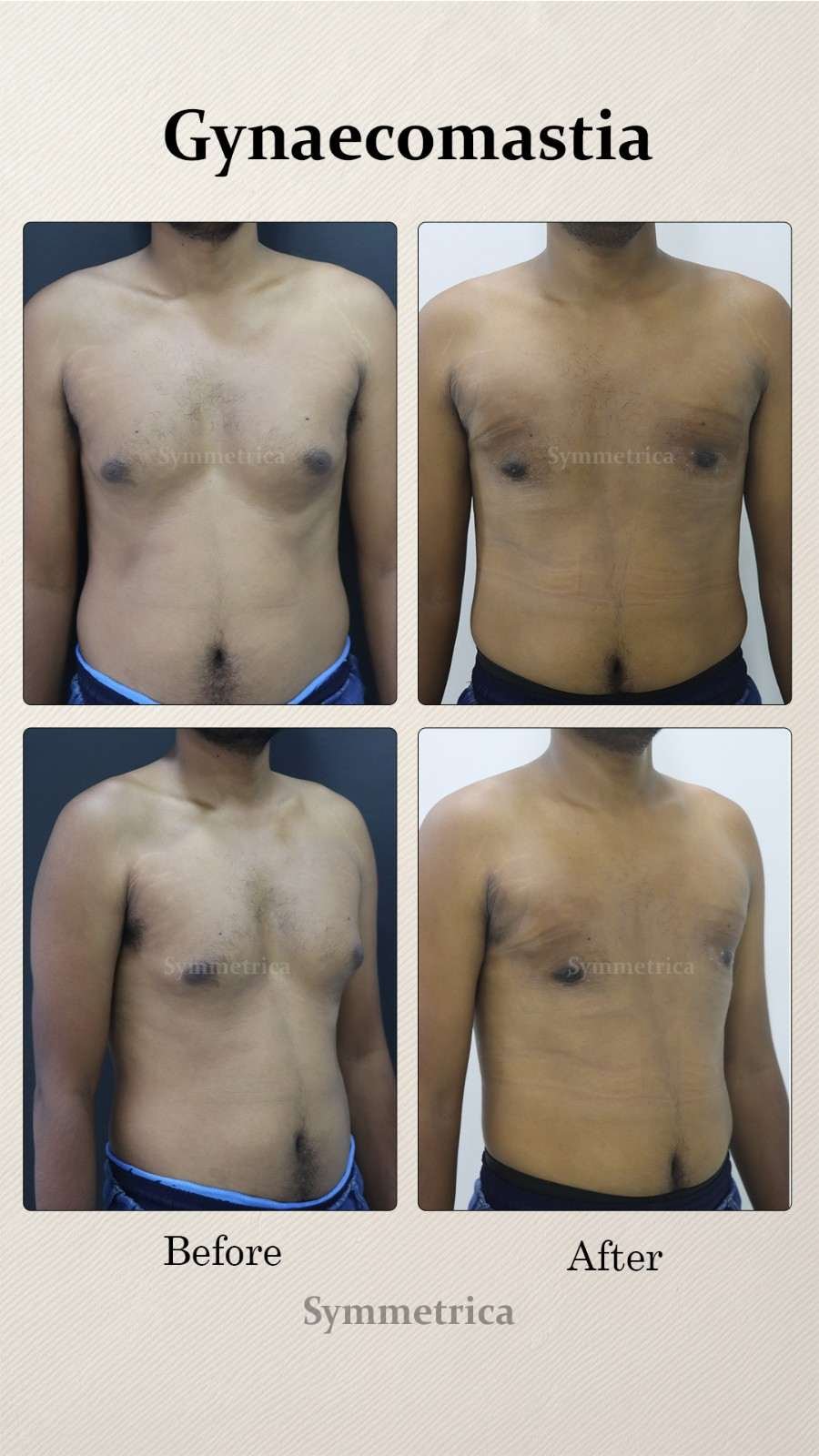 Gynecomastia consultation at Symmetrica, Siliguri