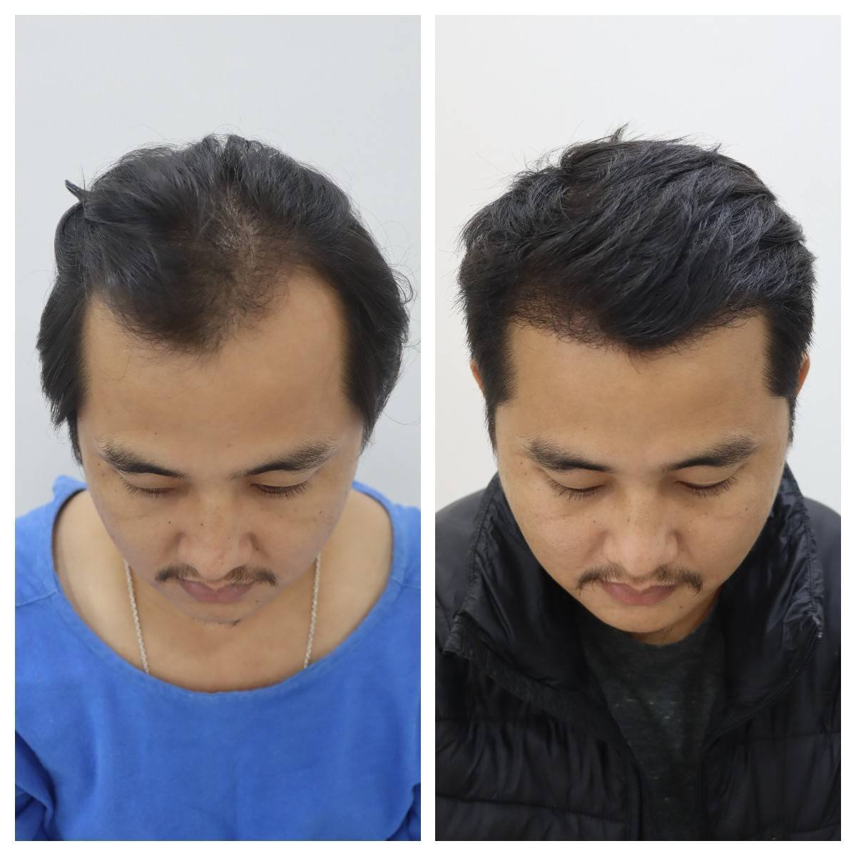 Hair transplant consultation at Symmetrica, Siliguri