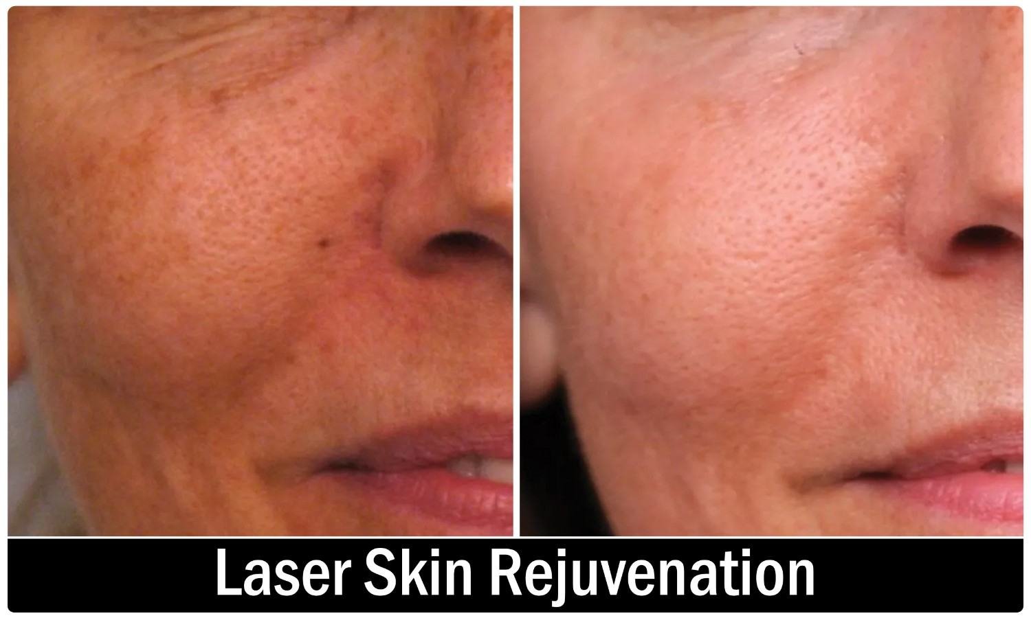 Laser treatment consultation at Symmetrica, Siliguri