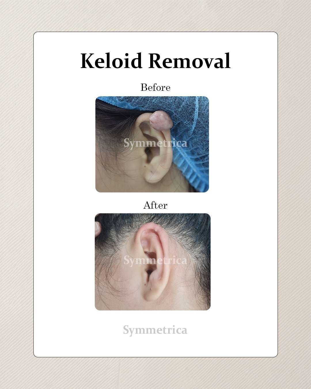 Scar revision consultation at Symmetrica, Siliguri