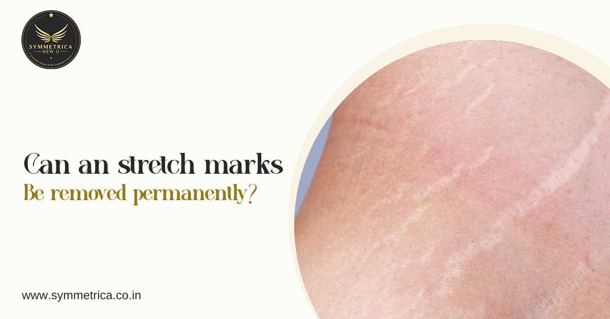 Stretch marks on skin with insights on whether stretch marks can be removed permanently and available cosmetic treatments