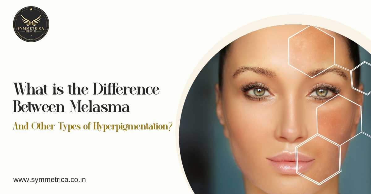 Woman with facial melasma and hyperpigmentation patches illustrating the difference between melasma and other types of skin pigmentation