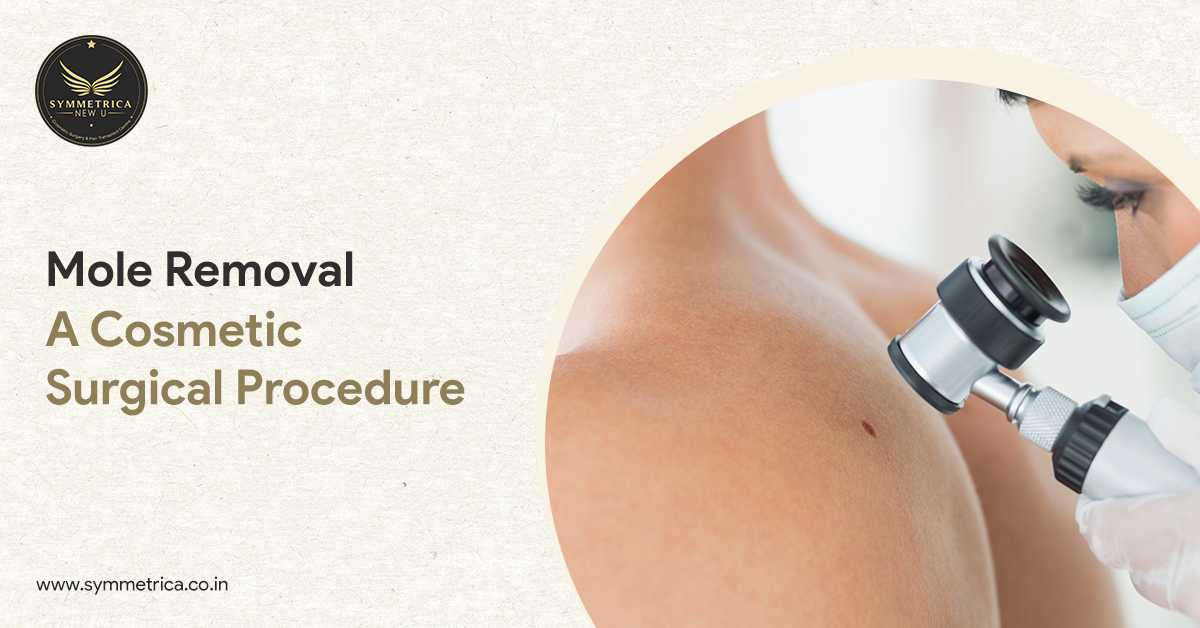 Mole Removal &ndash; A Cosmetic Surgical Procedure