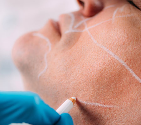 Laser Skin Rejuvenation