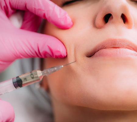  Dermal Filler for Smile Lines